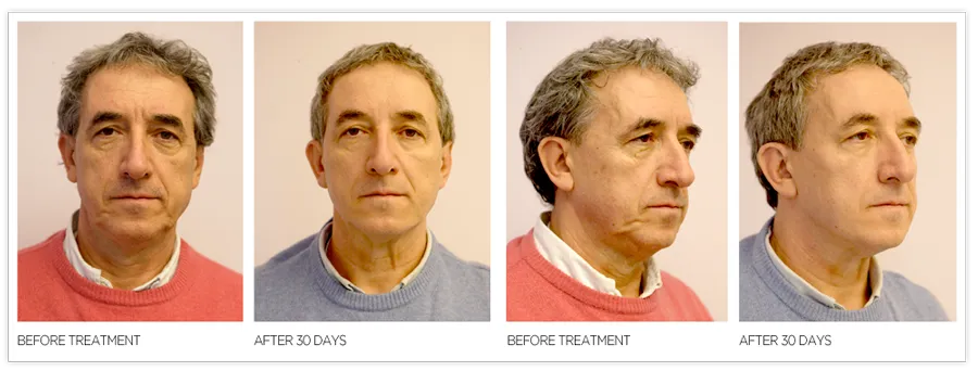 Threadlift Male 1920w